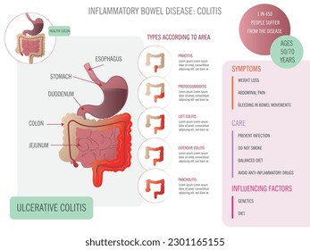 Infographic about ulcerative colitis types, symptoms, care with corresponding icons on white background