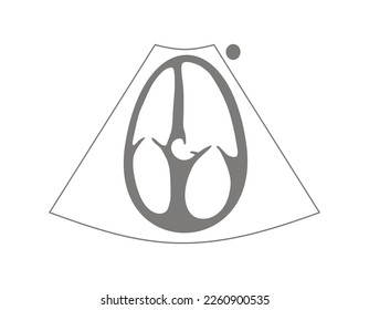 Infographic of Apical five chamber for measuring vti