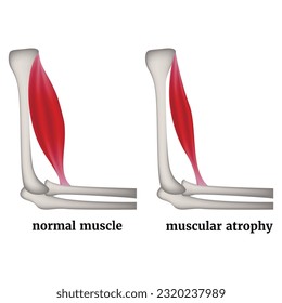 Infographic with arm muscle atrophy. Medical poster. Vector illustration