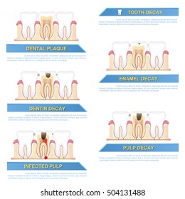 Infographic Dental Caries, Stages Of Tooth Decay
