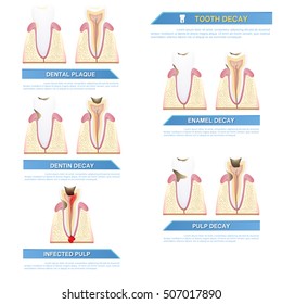 Infographic Dental Caries, Stages Of Tooth Decay
