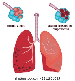 Infographic with emphysema. Normal and damaged bronchus.Medical poster,Vector illustration