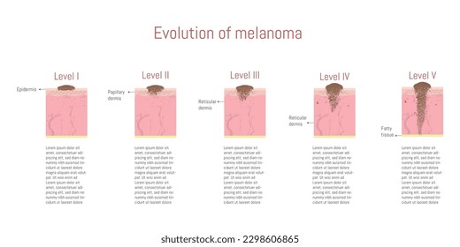 Infographic of the evolution of melanomas according to their levels and the area affected on the skin, graphic of the parts of the skin on a white background.