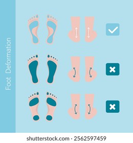 Infographic with feet deformation. Foot pathologies. Difference between diseased and healthy feet. Medical problem of foot or ankle curvature or deformity, valgus deformity. flat ector illustration