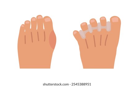 Infographic for feet health. Tight toes before, waring toe spacers, natural foot anatomy.