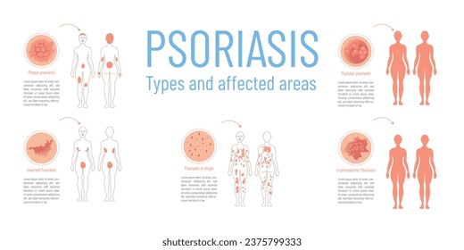 Infographic with graphic representation of the different types of psoriasis and the areas on the body that are affected.