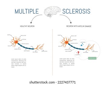 Infografía de una neurona sana y una con daño por ataque de linfocitos y macrófagos destructores de la mielina en enfermedad de esclerosis múltiple.