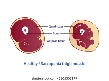 Infographic of healthy and sarcopenia thigh muscle vector illustration isolated on white background. Cross section of strength and losing muscle mass. Anatomy and health care concept illustration.