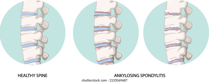 Infographic of healthy spine and ankylosing spondylitis illustration