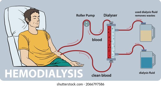 Infographic of hemodialysis, a procedure where a dialysis machine are used to clean blood - vector