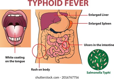 typhoid fever