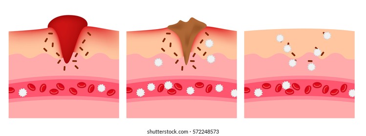 infographic of how the wound heal by platelet and white blood cell vector