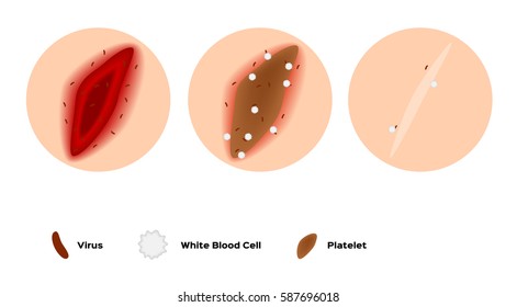 Infographic Of How The Wound Heal By Platelet And White Blood Cell Vector