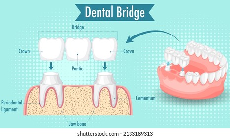 Infographic of human in dental bridge illustration