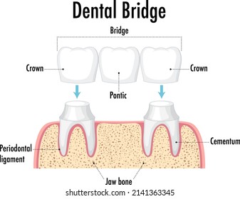 Infographic of human in dental bridge on white background illustration