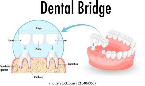 Infographic of human in dental bridge on white background illustration