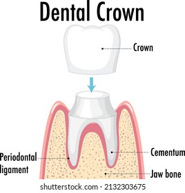 Infographic of human in dental crown illustration