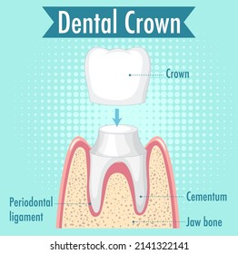 Infographic of human in dental crown illustration