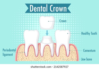 Infographic of human in dental crown illustration