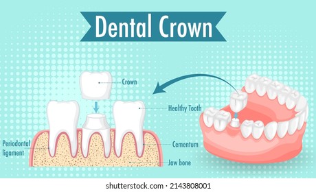 Infographic of human in dental crown illustration