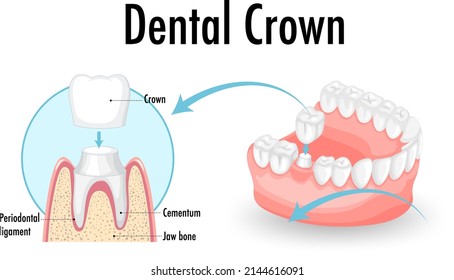 Infographic of human in dental crown illustration