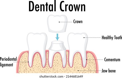 Infographic of human in dental crown illustration