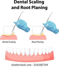 Infographic of human in dental scaling and root planing illustration