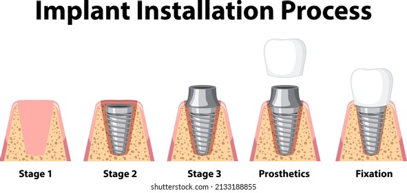 Infographic of human in implant installation process illustration
