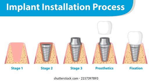 Infografik von Menschen in der Implantatinstallation, Prozessgrafik