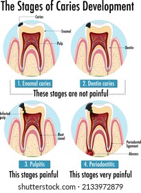 Infographic of human in the stages of caries development illustration