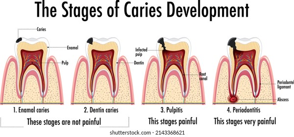 Infographic of human in the stages of caries development illustration