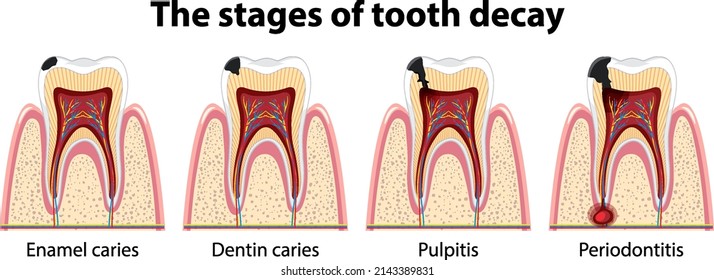 Infographic Of Human In The Stages Of Tooth Decay Illustration