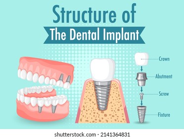 Infographic of human in structure of the dental implant illustration