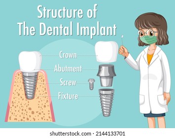 Infographic of human in structure of the dental implant illustration