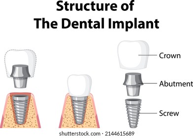 Infographic of human in structure of the dental implant illustration