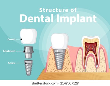 Infographic of human in structure of the dental implant illustration