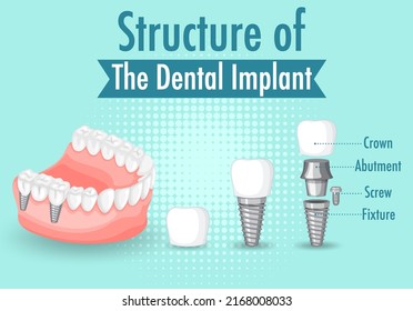 Infographic of human in structure of the dental implant illustration