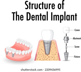 Infographic of human in structure of the dental implant illustration