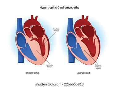 Infographic hypertrophic cardiomyopathy. Eps 10