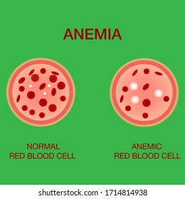Imagen infográfica de la anemia. La diferencia entre la cantidad de glóbulos rojos y la cantidad normal de anemia. Imagen vectorial realista de los glóbulos rojos o de la cantidad de hemoglobina en sangre humana. Médico   concepto