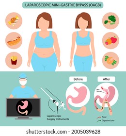 Infographic Of Laparoscopic Mini-gastric Bypass (OAGB) Illustration. Weight Loss Surgery Vector.