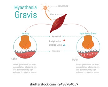Infographic of myasthenia gravis disease.schematic of the nerve cell with or without the disease.

