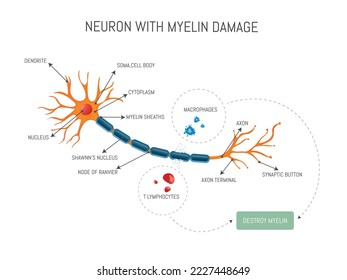 Infografía de una neurona dañada por un ataque de linfocitos y macrófagos que destruye la mielina en la enfermedad de esclerosis múltiple.