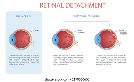 296 Retinal arteries and veins Images, Stock Photos & Vectors ...