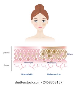 Infographic of normal and melasma skin on woman face vector illustration. Comparison of healthy epidermis skin layer, hyperpigmentation, melasma and dark spots. Skin care and beauty concept.