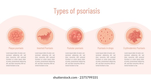 Infographic on the type of psoriasis and what it looks like.