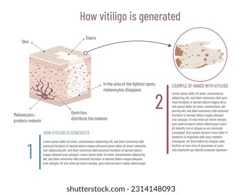 Infographic of the origin of vitiligo and visual example on the hands, skin structure and affected area on white background.