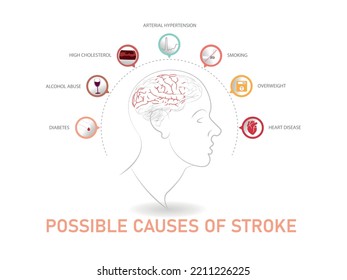 Infografía de las posibles causas de la apoplejía. silueta de cabeza y cerebro sobre fondo blanco.