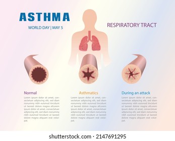Infografik der Atemwege in einem Asthma-Prozess.
