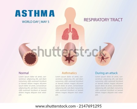Infographic of the respiratory tract in an asthma process.
